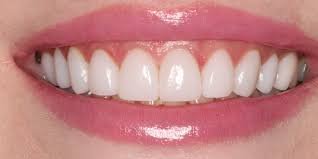 Teeth Whitening